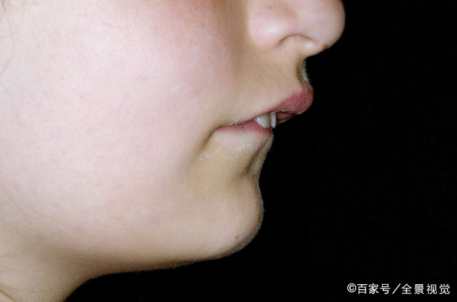 用嘴巴呼吸 长时间用嘴巴呼吸会引起口腔颌骨发育畸形,会导致嘴巴外凸